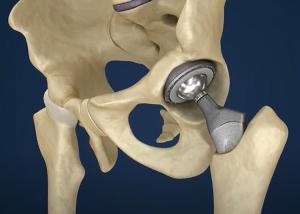 Hip implant